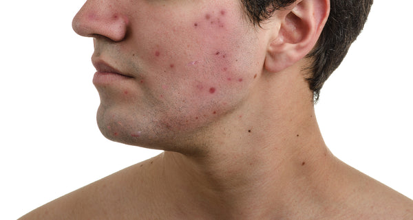 Do You Know How To Get Rid Of Acne?