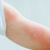 Would You Know What To Do If Your Child Had Hives?