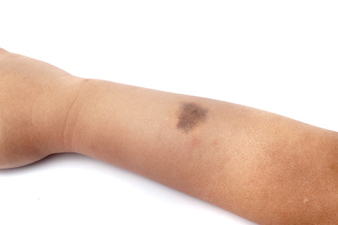 Does Mens Skin Cancer Knowledge Lag Behind Womens?