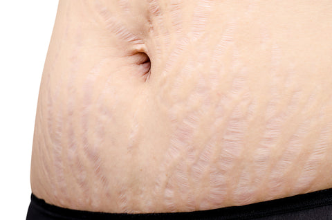 Natural Stretch Mark Treatment Options