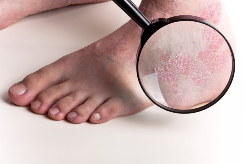 Treating Eczema: Do You Know The Natural Ways?