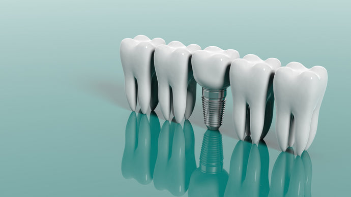 How Dental Implants Can Help You Mentally And Physically