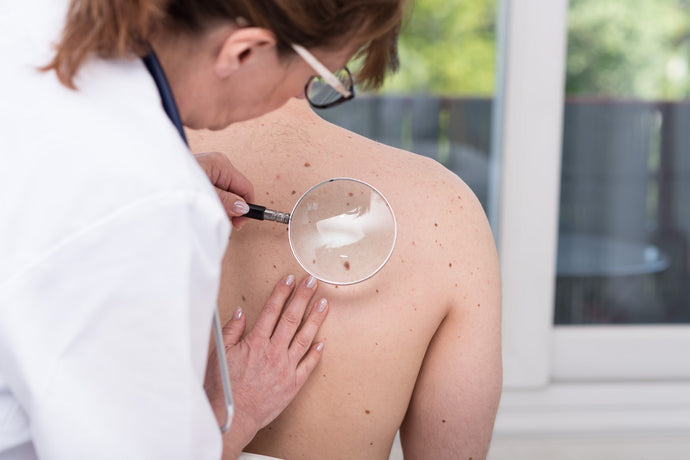 Mole Or Skin Cancer? How To Tell The Difference