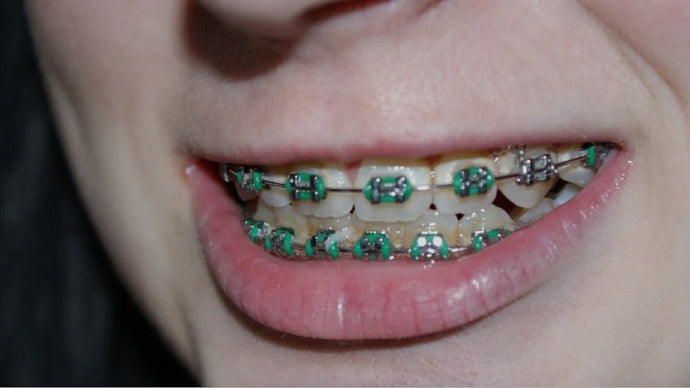 Under What Circumstances Are Dental Braces Medically Necessary?