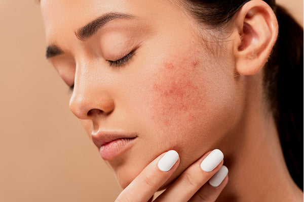 woman with acne makeup tips