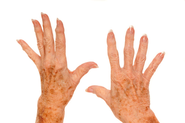 hands with age spots