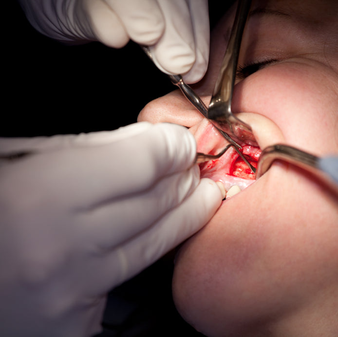 What Causes Bleeding Gums?