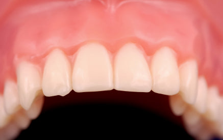 Do You Know The Signs And Symptoms Of Bleeding Gums?