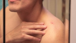 man with boils and styes treating himself 