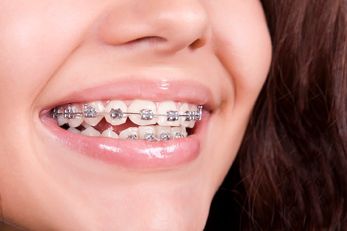 Popular Adult Braces And Aligners Myths Debunked