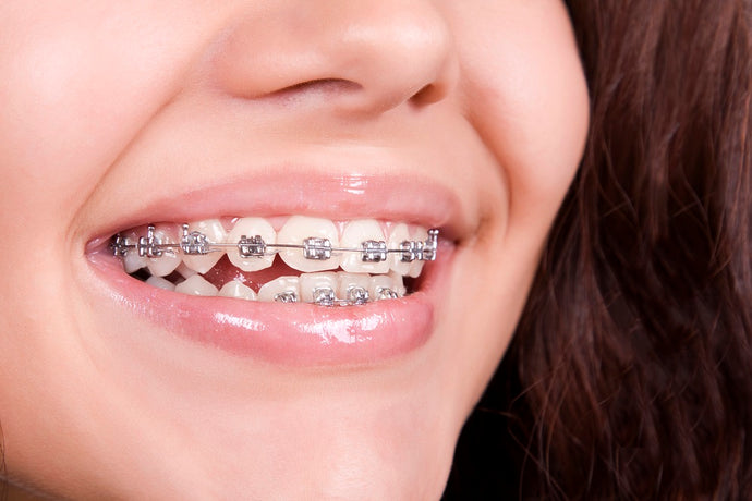 Important Things To Do Before And After Getting Braces
