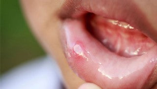 The Signs And Symptoms Of Canker Sores