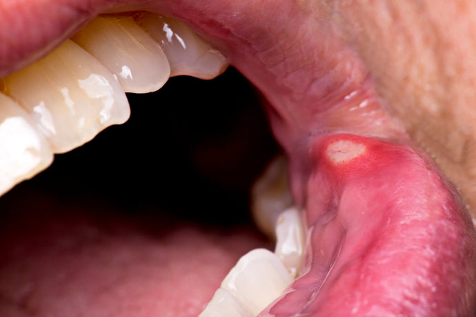How To Prevent Canker Sores