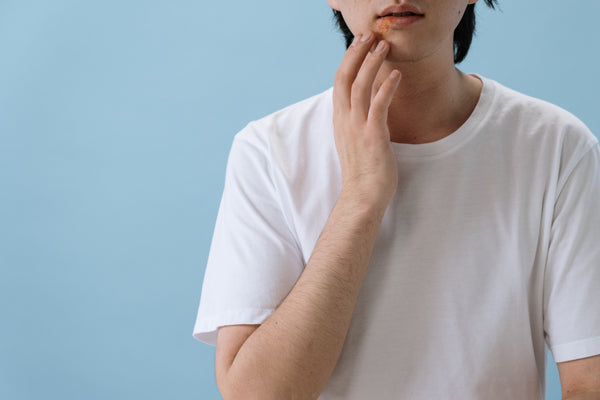 boy with canker sore or cold sore