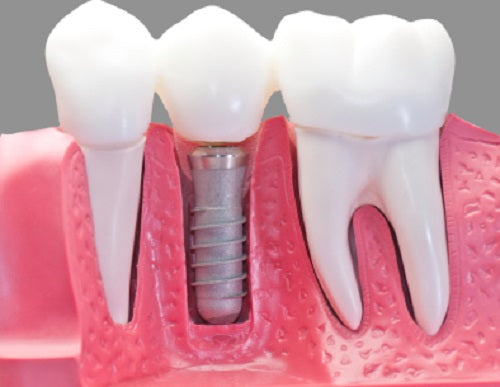 Holistic Dentistry For Tooth Replacement Via Dental Implants