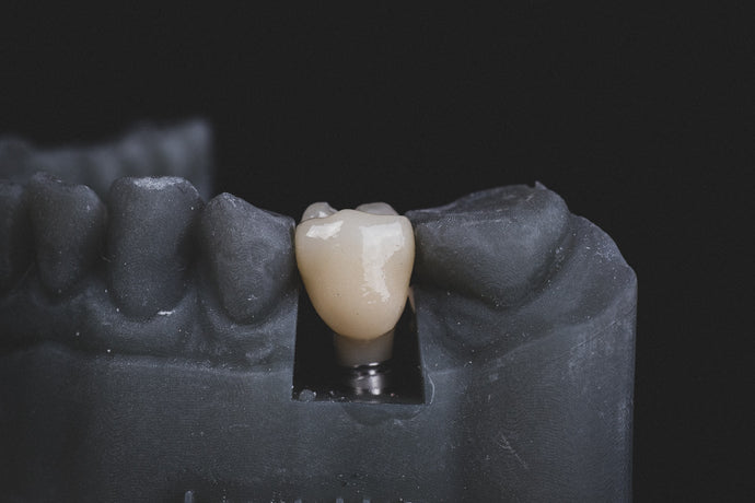 Understanding Dental Implants And When You Might Benefit From Them