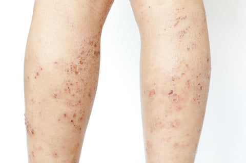 Eczema Can Have Many Effects On Patients Health