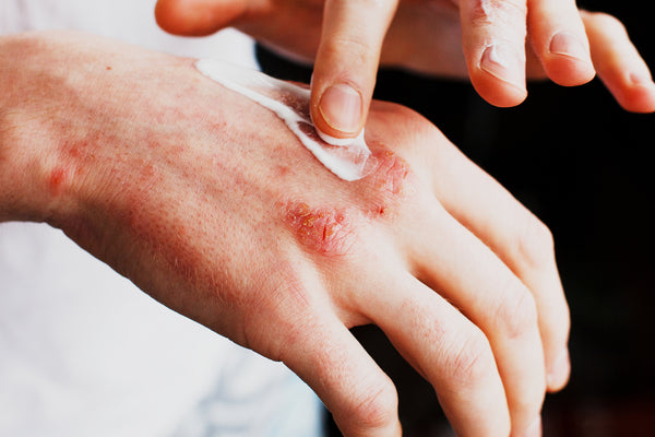 person rubbing psoriasis lotion on hand