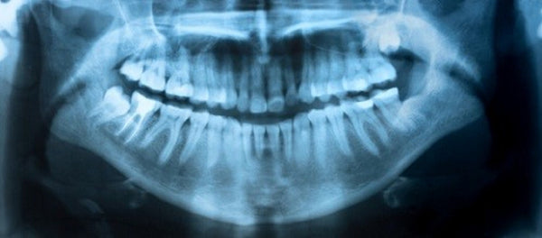 dental X-ray for gum disease cancer