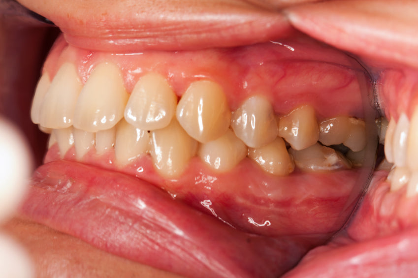infected gums