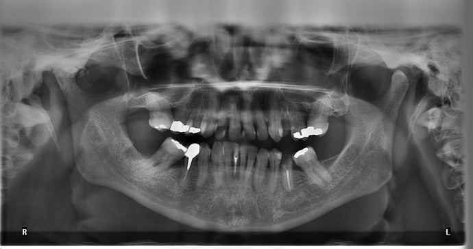 Hairline Tooth Fracture: All You Need To Know