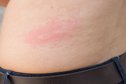 Hives: Signs, Symptoms Prevention And Treatments