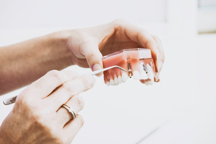 What You Need To Do To Recover From Dental Implants