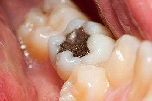 Dental Mercury Dangers