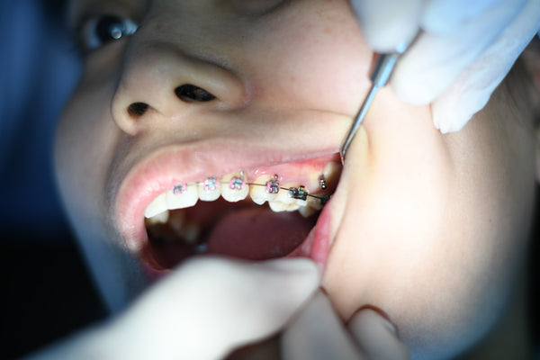 girl getting early orthodontic treatment