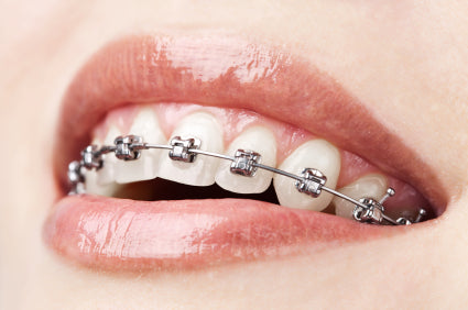 Can Orthodontics Prevent Future Tooth Decay?