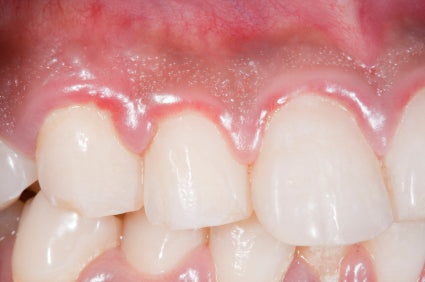Reasons For Red Gums