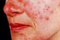 Rosacea: What It Is And How To Help It