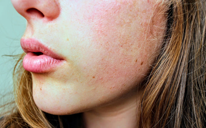 4 Common Skin Concerns And How To Fix Them
