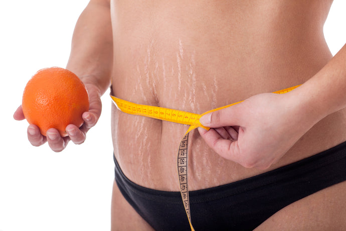 Stretch Marks: What You Can Do To Help Them Fade