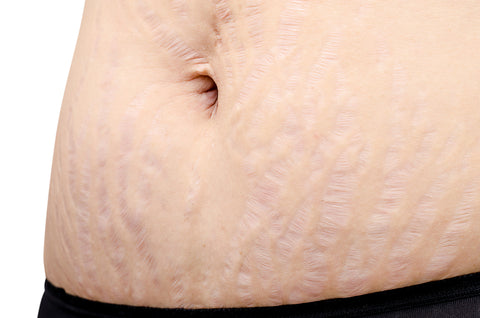 Stretch Marks  Prevention And Treatment