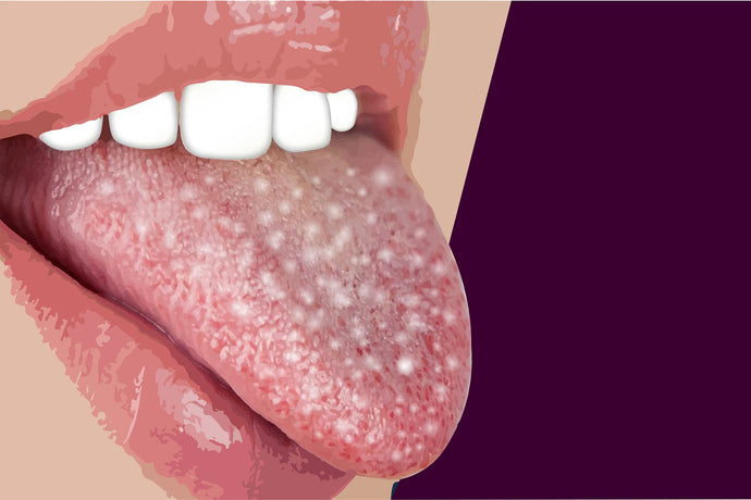 What To Do If Your Tongue Turns White