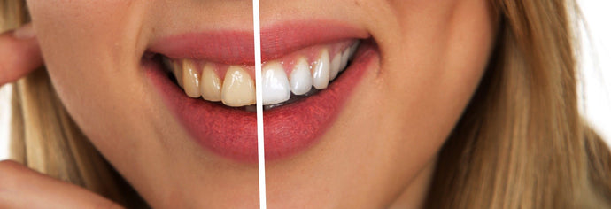Teeth Whitening - In-Office Vs. At-Home