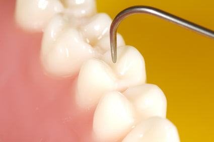 What Causes Tooth Decay?