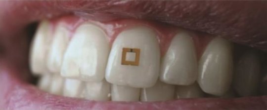 Tooth-Mounted Sensors Track What You Eat