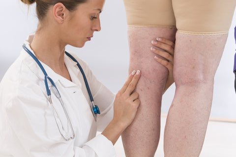 The Signs And Symptoms Of Varicose Veins