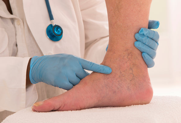 doctor checking and reducing the appearance of varicose veins on the foot